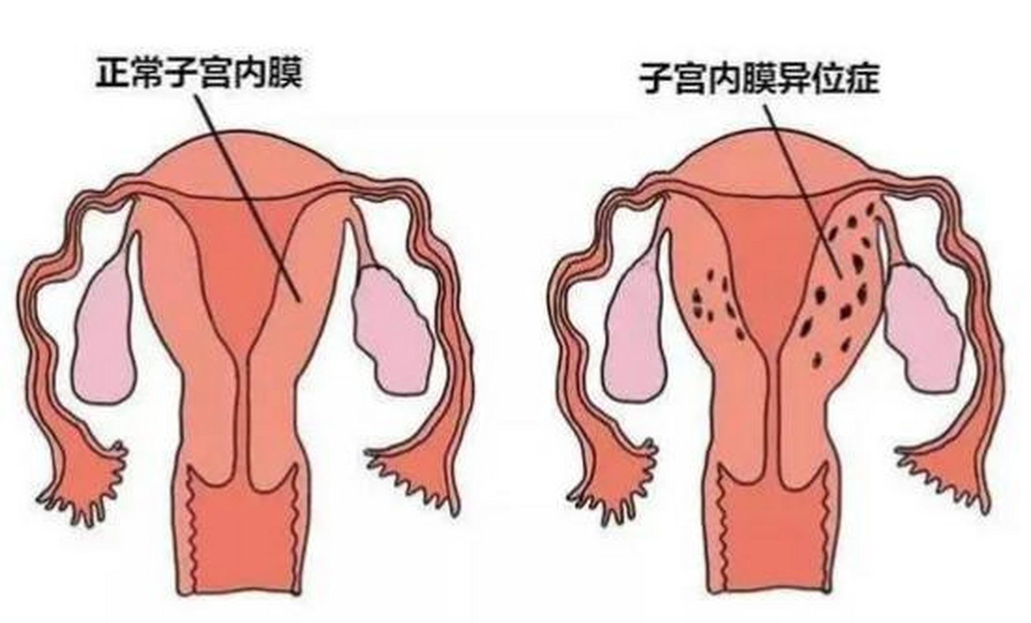 宫颈肥大同房有啥症状图片