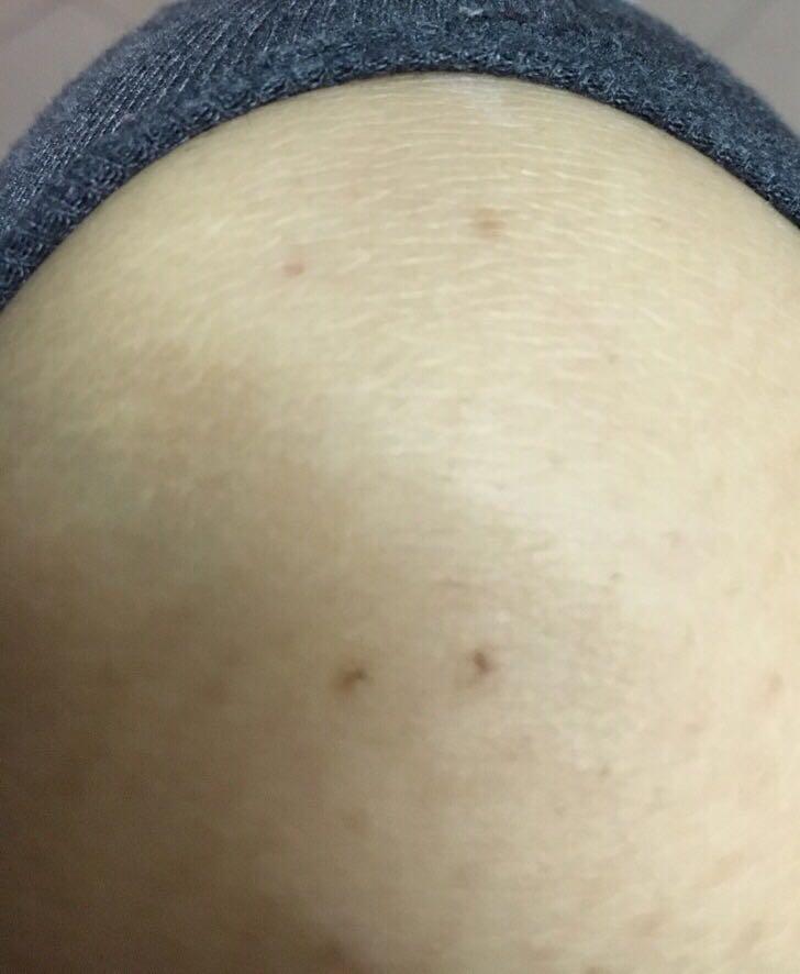 老鼠咬到到底要不要注射狂犬病疫苗网上有说要也有说不要专业人士请