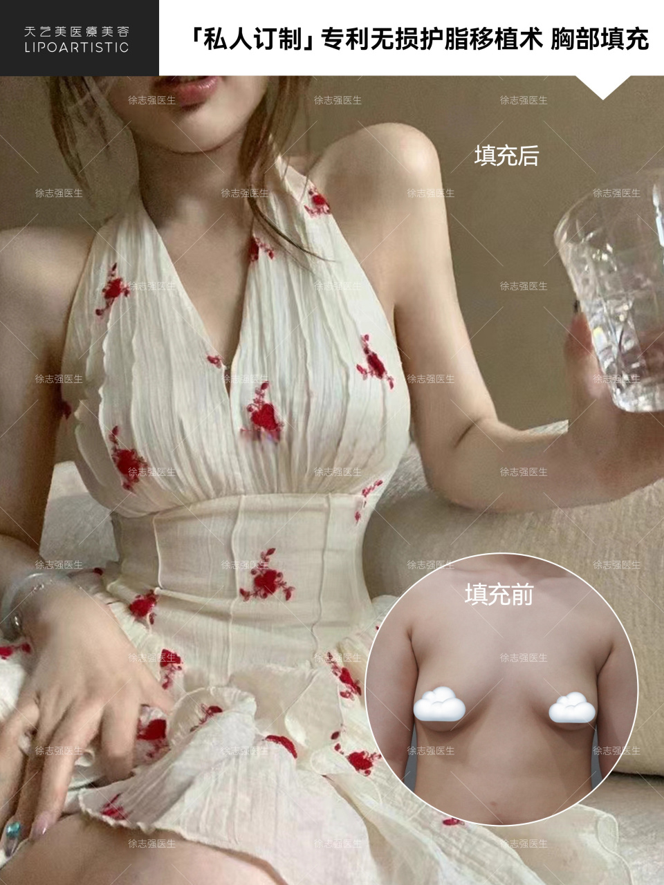 【脂肪胸部填充】术后4个半月返图 改善术前轻微下垂 升级罩杯,美女对