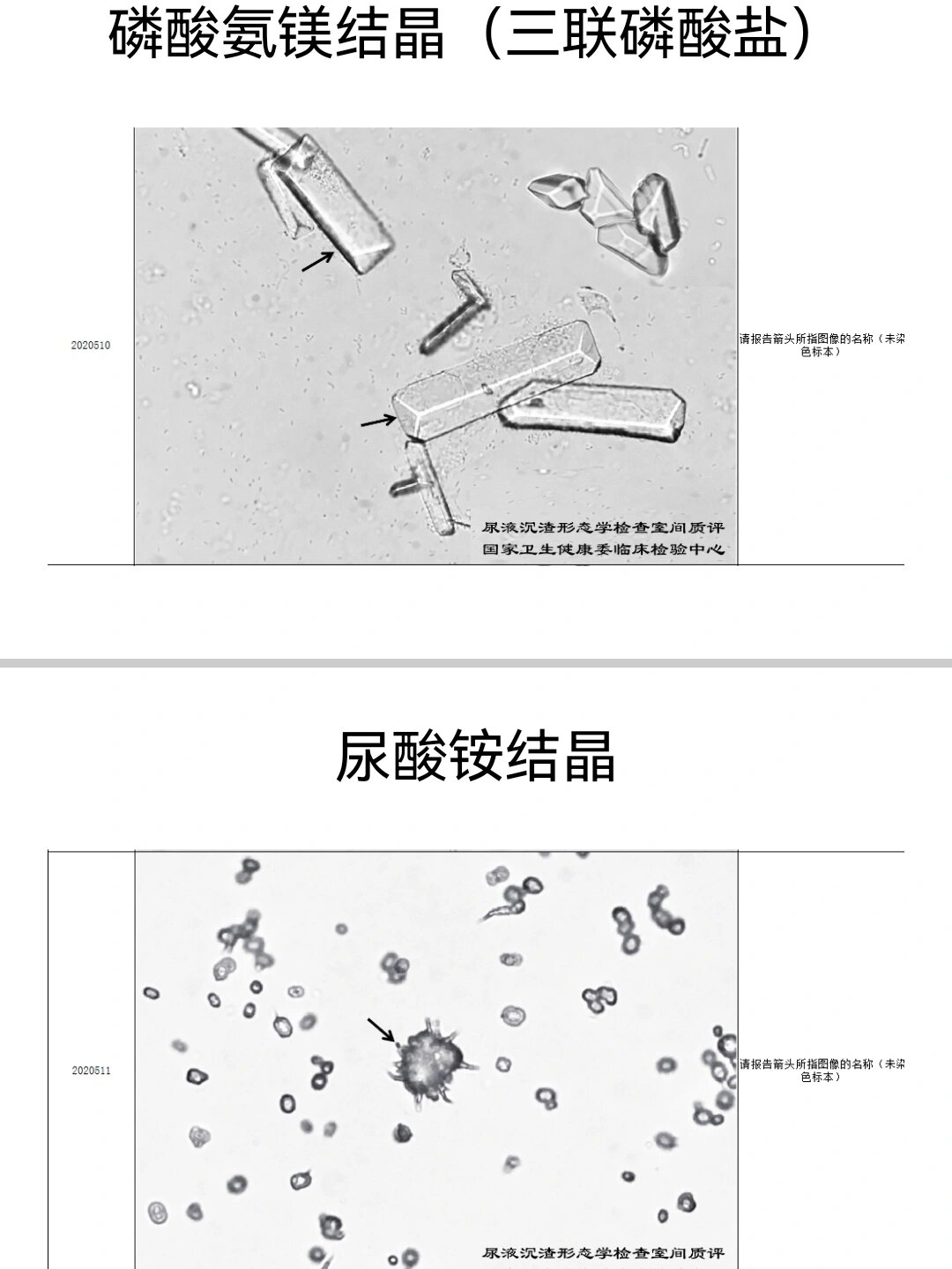 尿沉渣图谱结晶图片