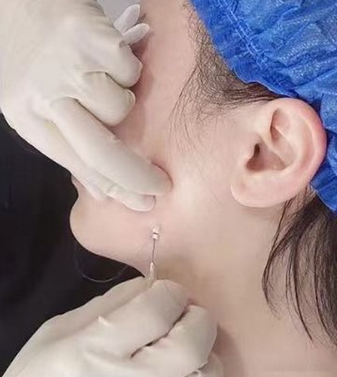 下颌缘松弛伴有脂肪下垂非常影响侧面观的脸型,做了超