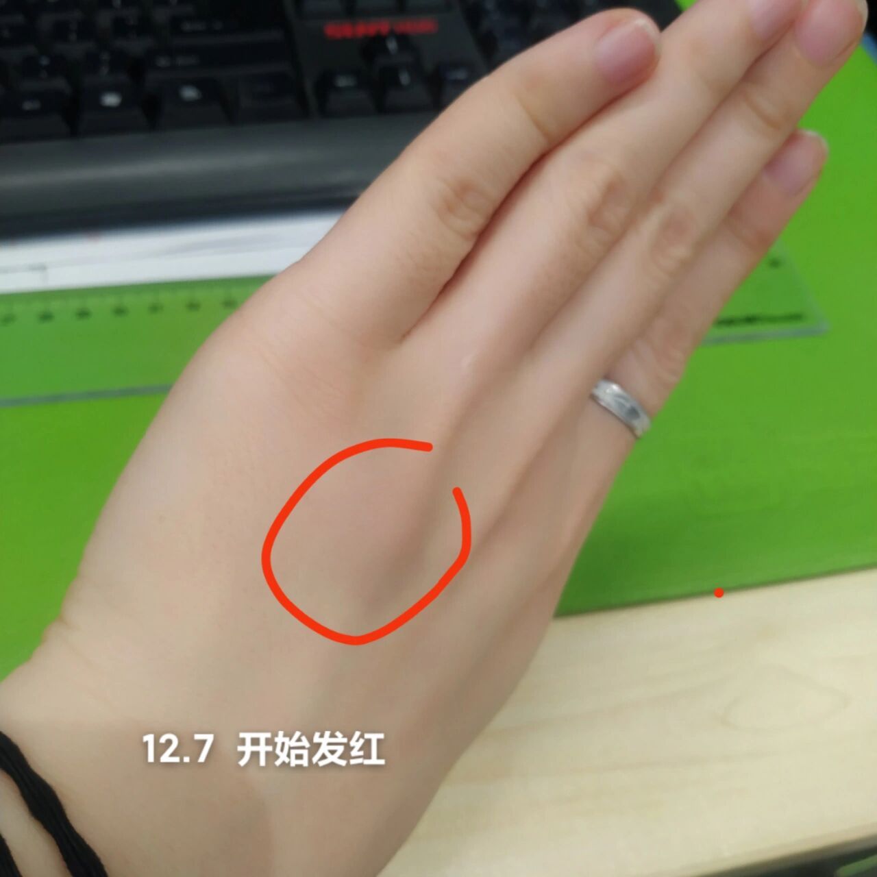 痛死了 手背无名指活动的那根筋上莫名其妙出现一个痘痘大小的包.