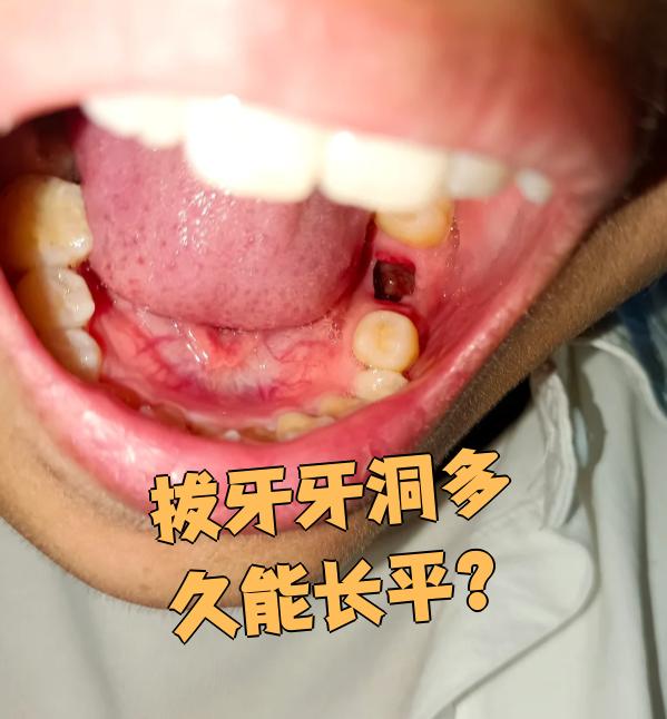拔牙后留下的牙洞通常需要分阶段愈合