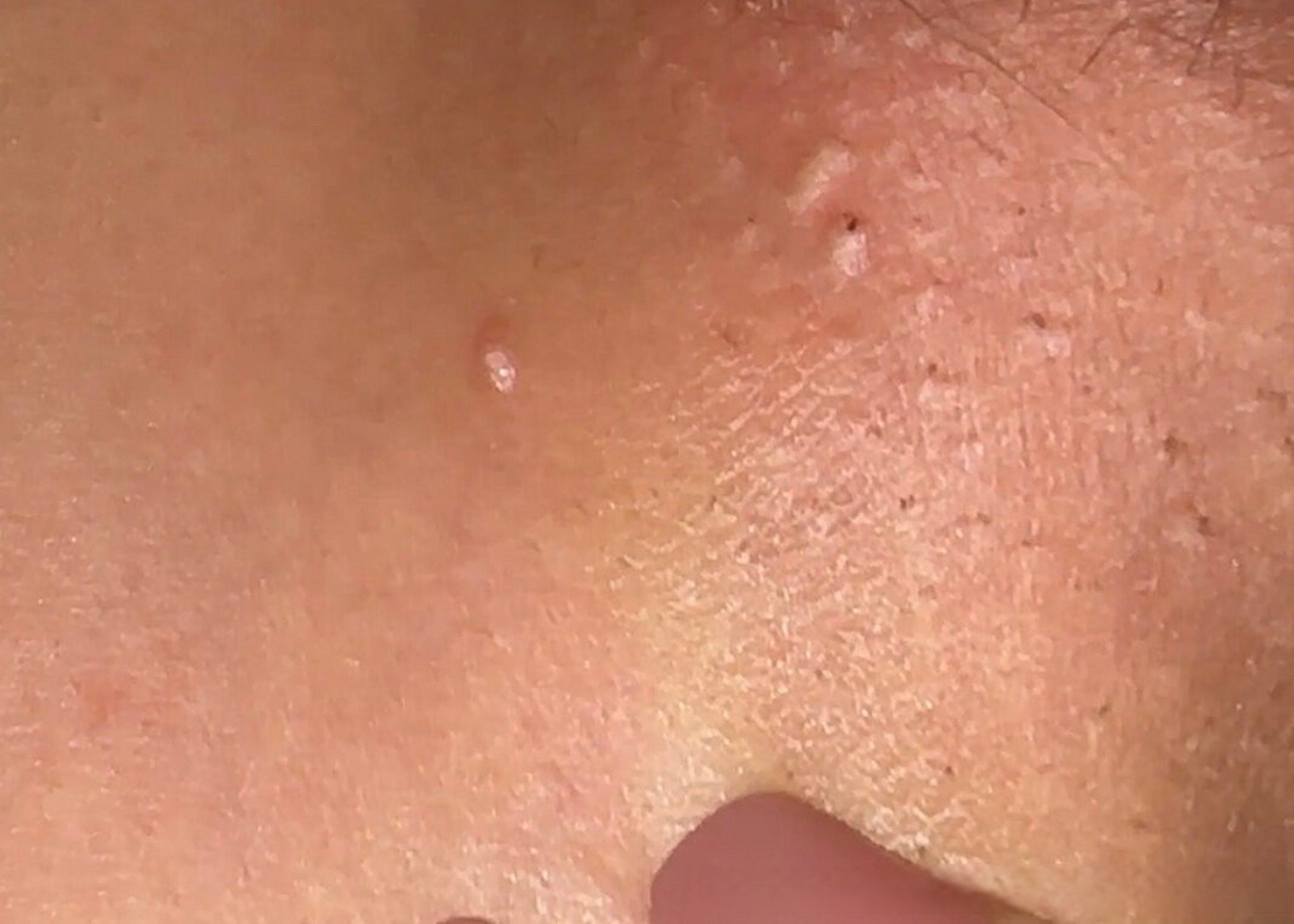 爱问医生诊室# 在大腿根内侧长痘痘有1颗冒白头不清楚是粉刺还是尖锐