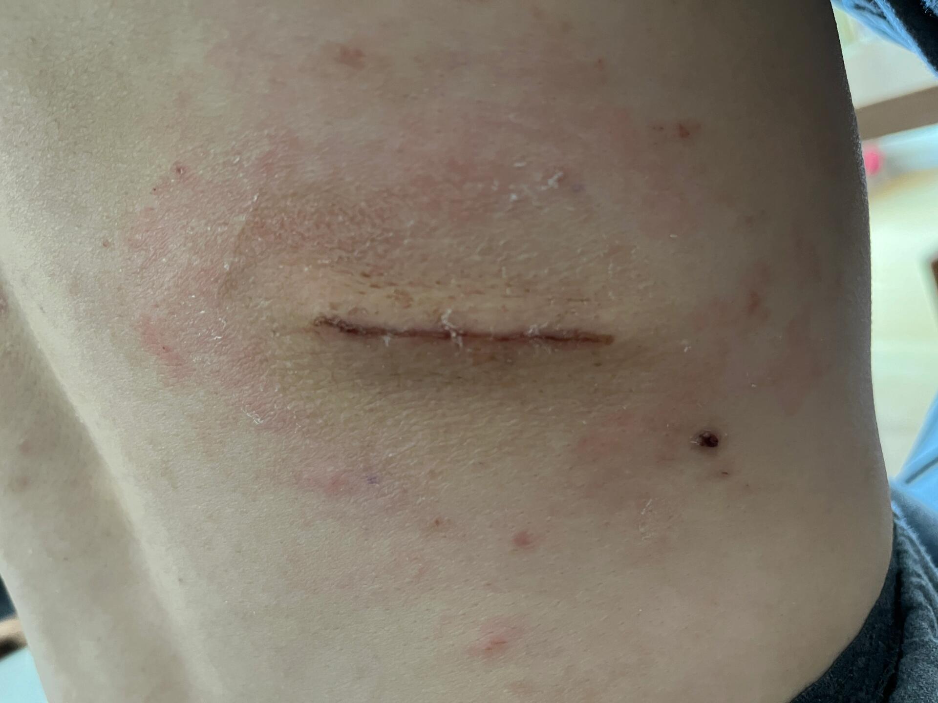 脂肪瘤术后第12天恢复情况 背景:脂肪瘤大小7*5*2cm,选择北京大学第一