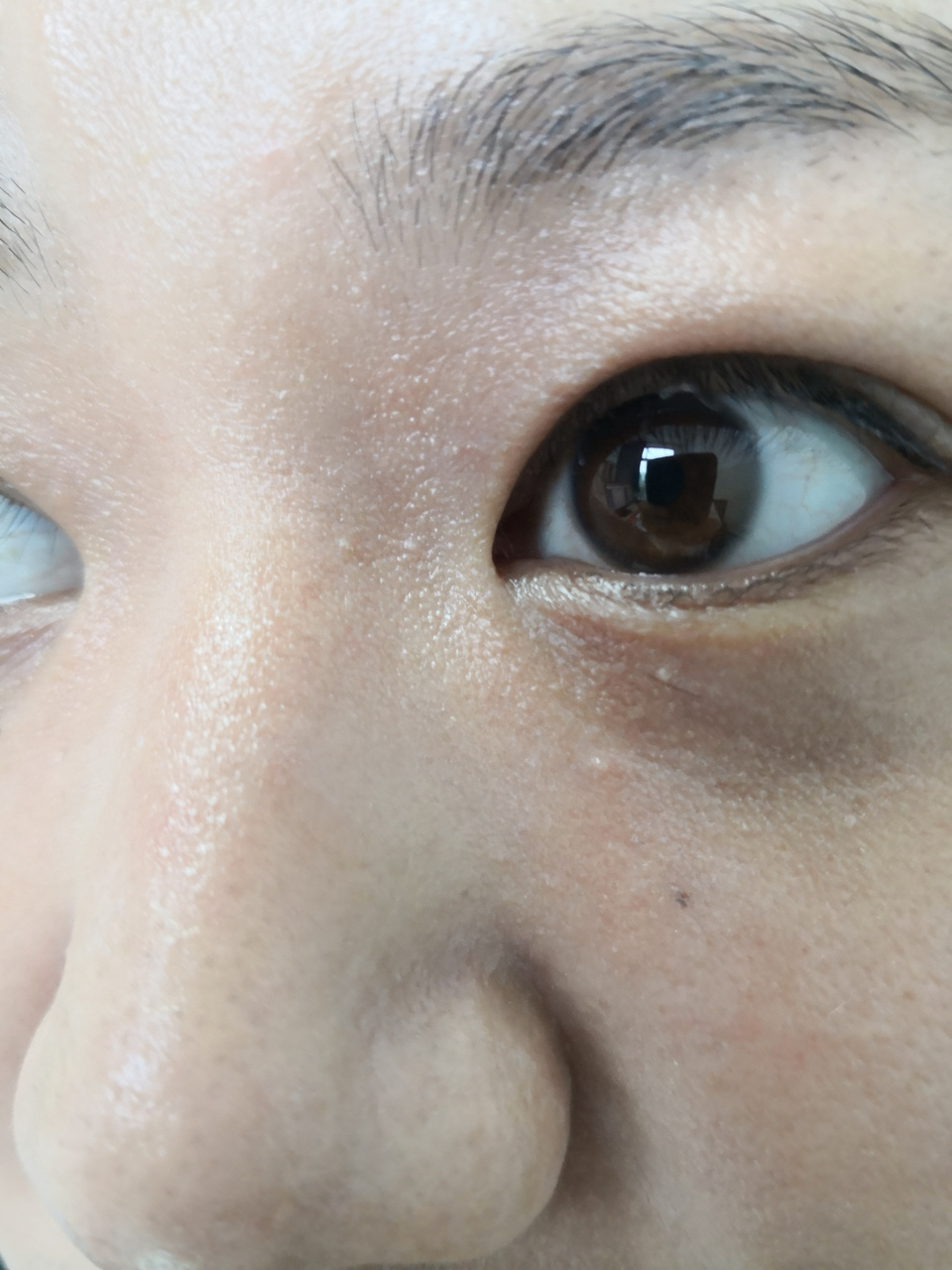 眼睑下方的丘疹,斑块,考虑汗管瘤和脂肪粒/粟丘疹