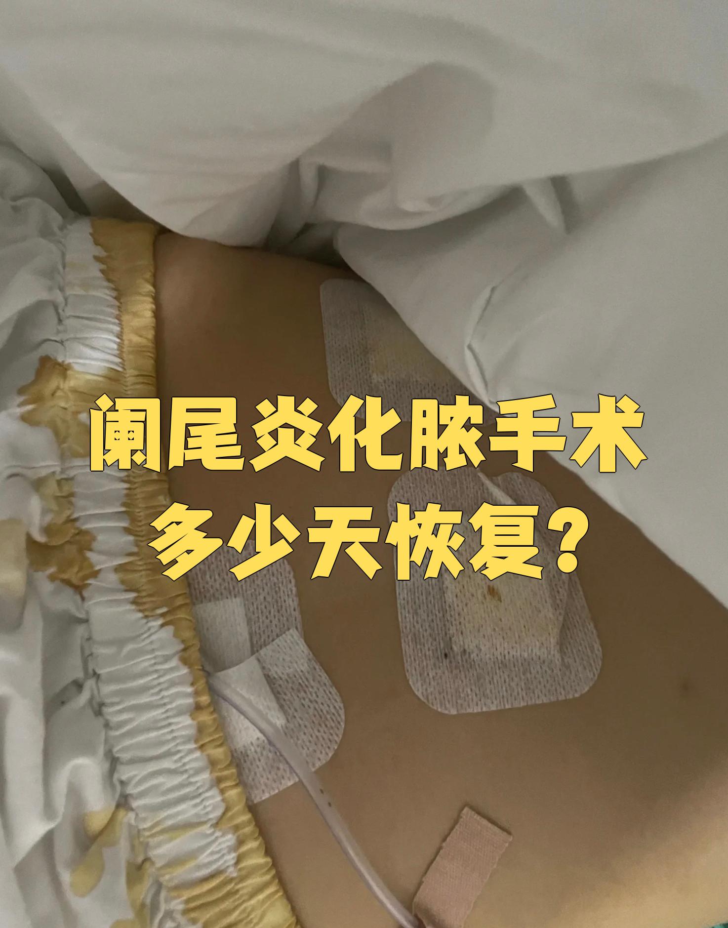 阑尾炎化脓手术后恢复时间要看具体情况