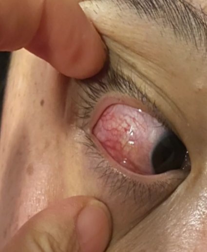 操作电焊时一定要做好防护,如果出现眼睛充血,疼痛等症状,要马上去