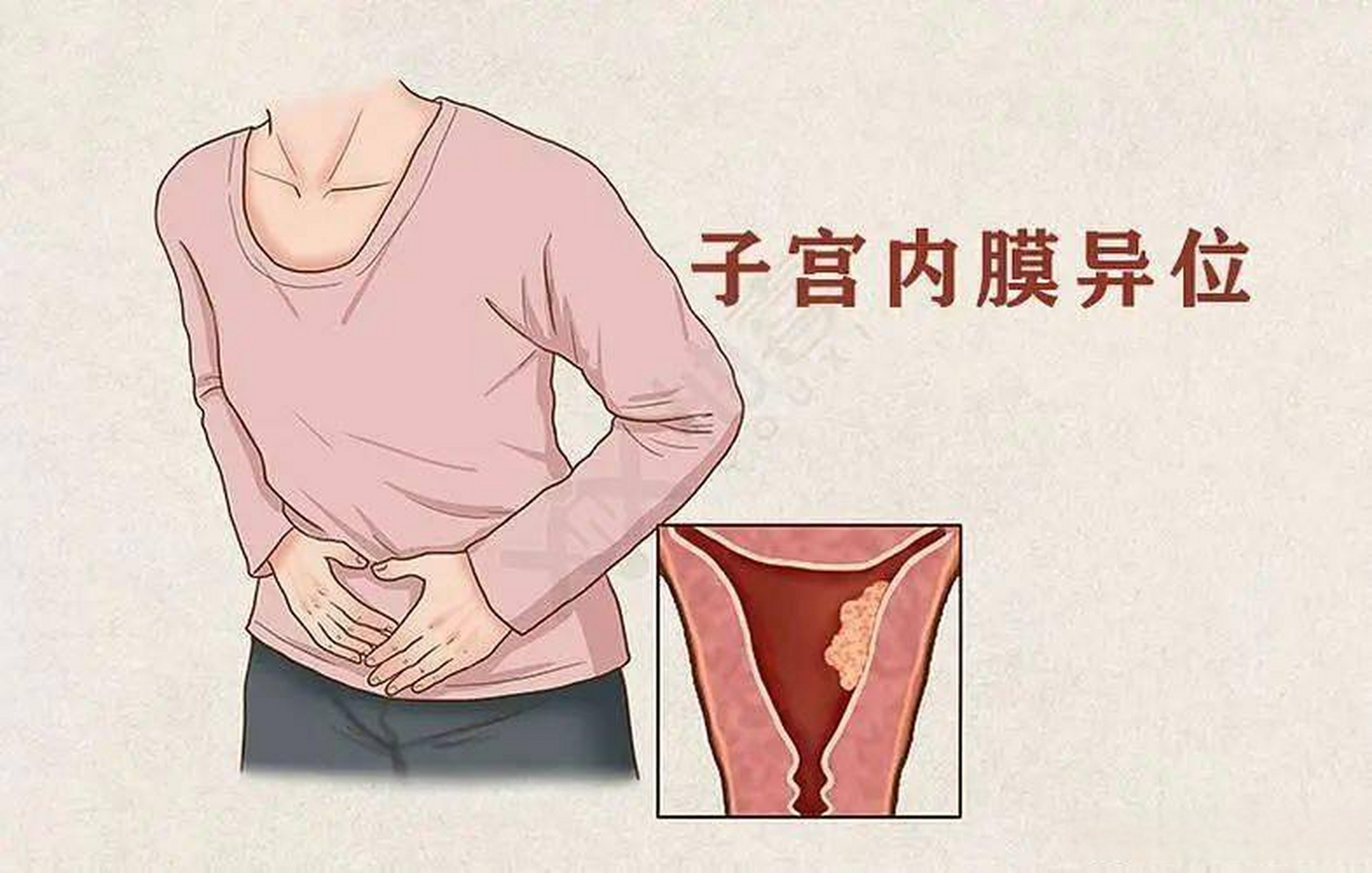 中医外治疗法调理子宫内膜异位症有良好效果 子宫内膜异位症是妇女的