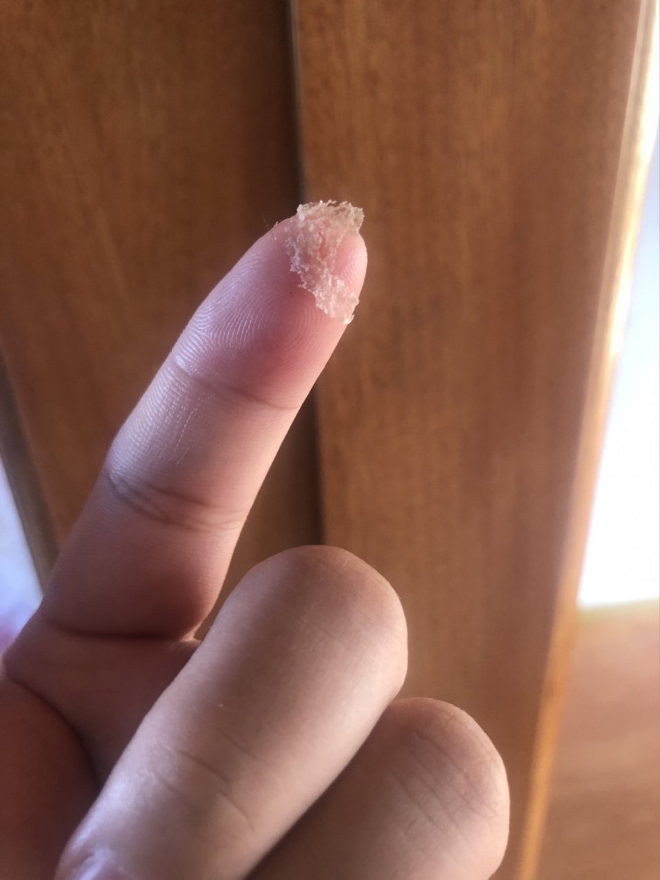 怀孕头皮屑会大块?疯了.