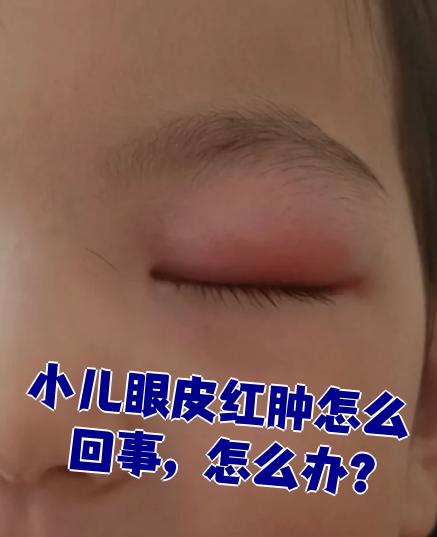 孩子眼皮红肿最常见的原因是揉眼睛引起的,但也可能是其他问题