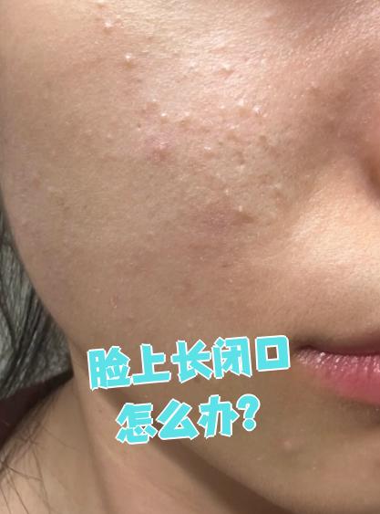 很常见,主要是毛孔堵塞造成的