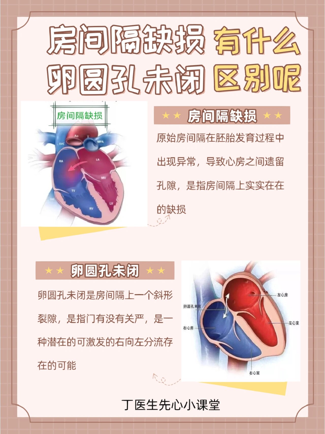 房间隔缺损和卵圆孔未闭有什么区别呢?