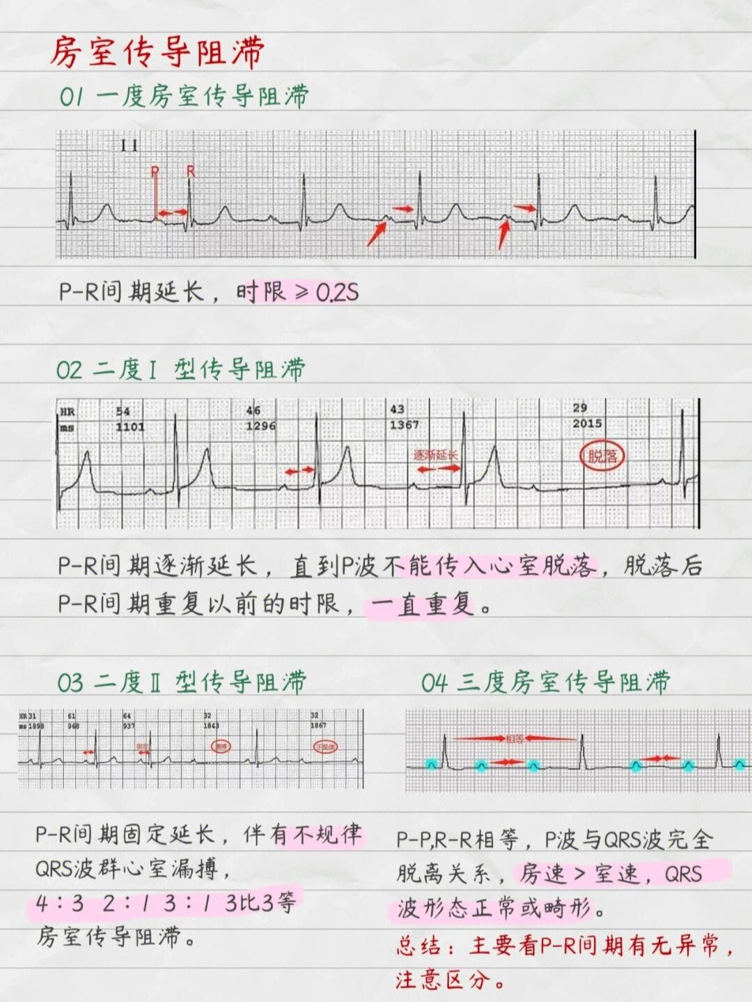 关于心电图最全波形图 #实习护士# #护考# #护士懂护士# #护士资格证