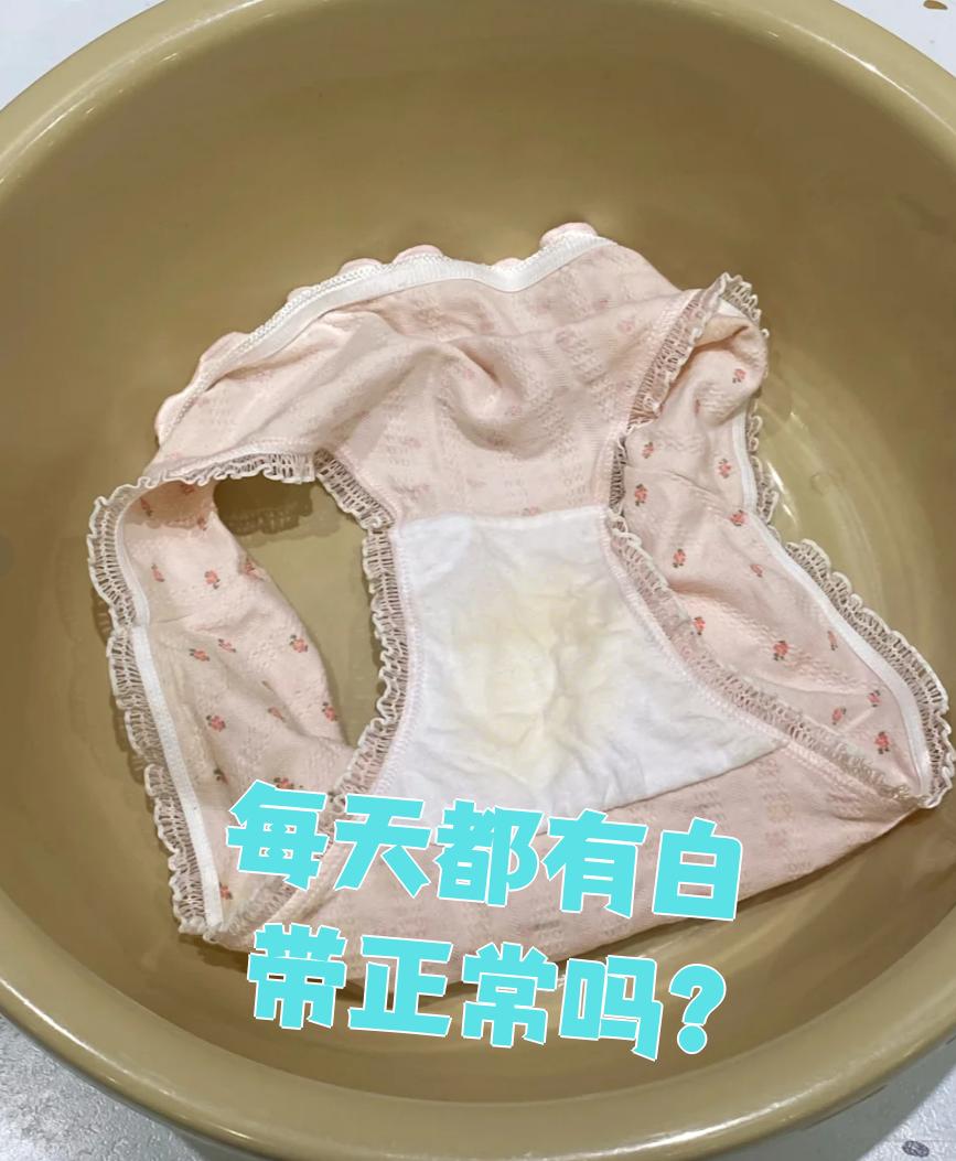每天有白带是正常的现象