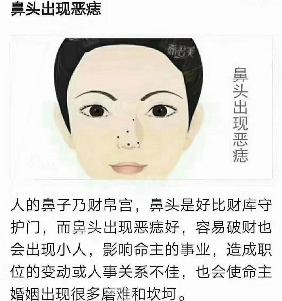 鼻子上的痣代表什么 都知道,医院里面有五官科,事关眼耳鼻舌口的病,都