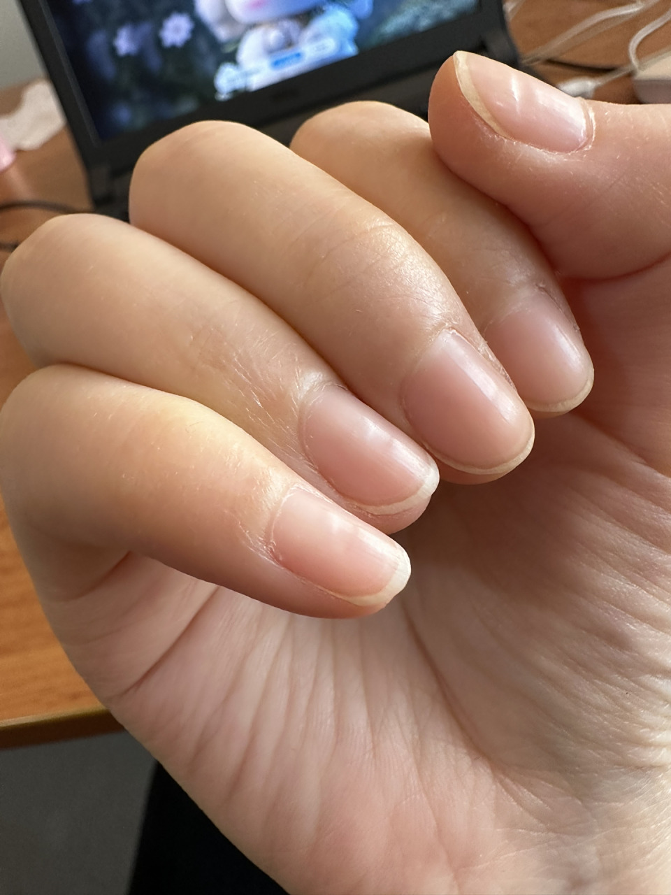 指甲凹陷是什么原因 十个指甲,每个指甲中部凹进去一点点,个别指甲也