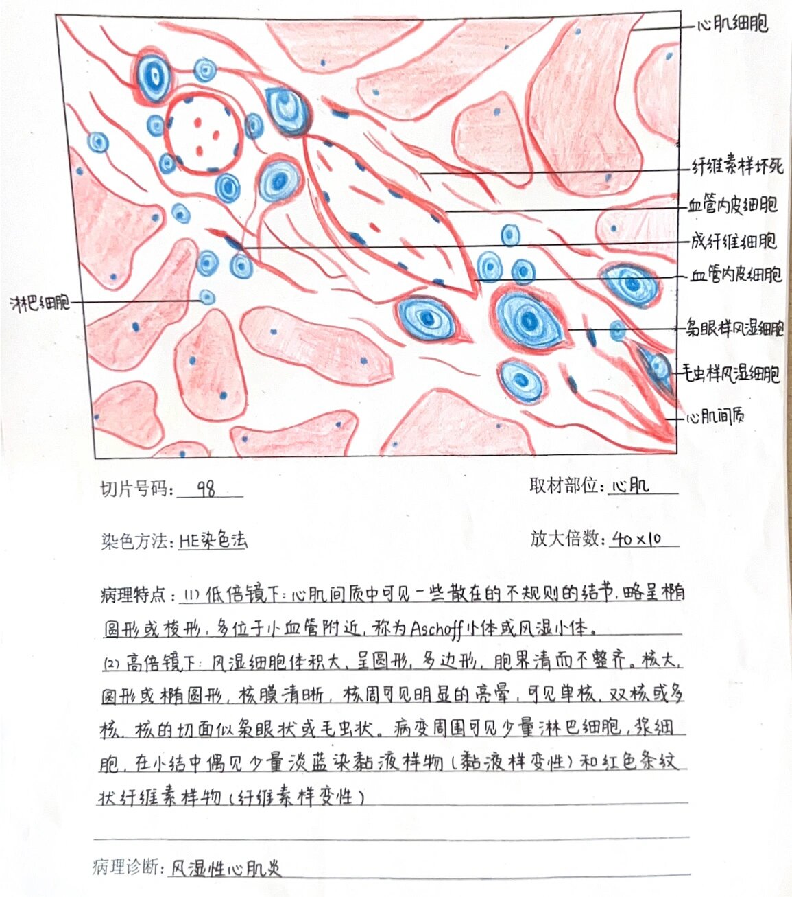 风湿性心肌炎病理图片