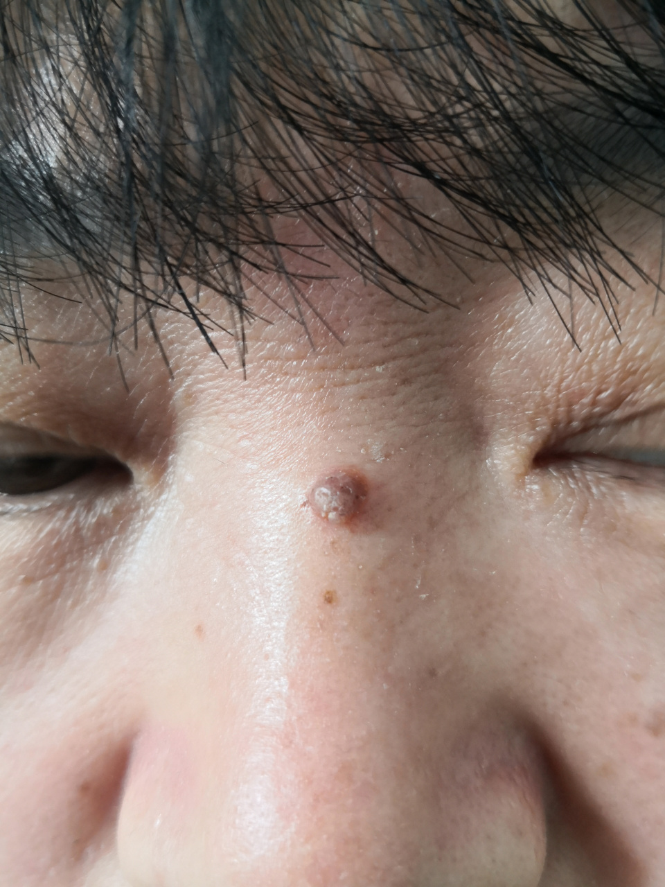 需要手术切除活检诊断一下确定色素痣解决皮肤问题专注