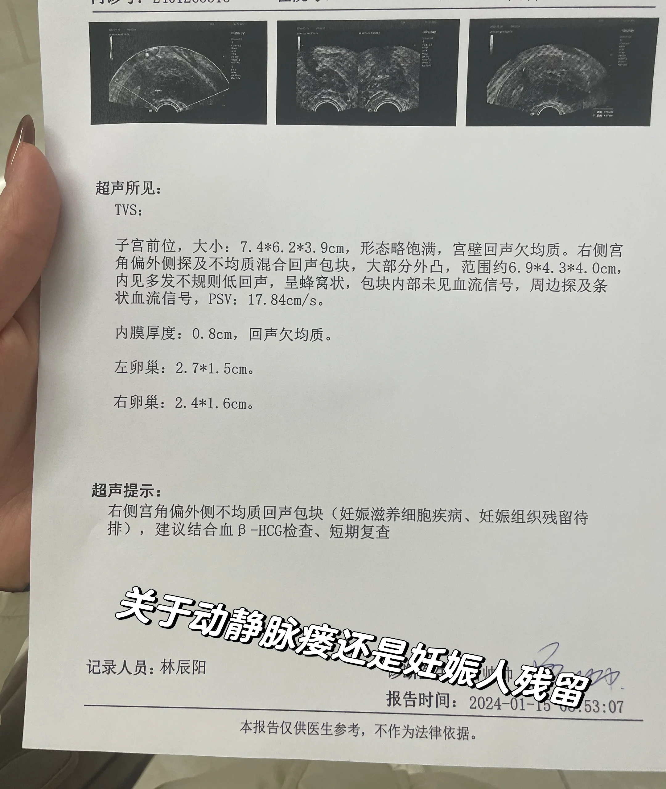 关于动静脉瘘还是妊娠残留,内容偏长供姐妹 1 我是属于自然流产,10月
