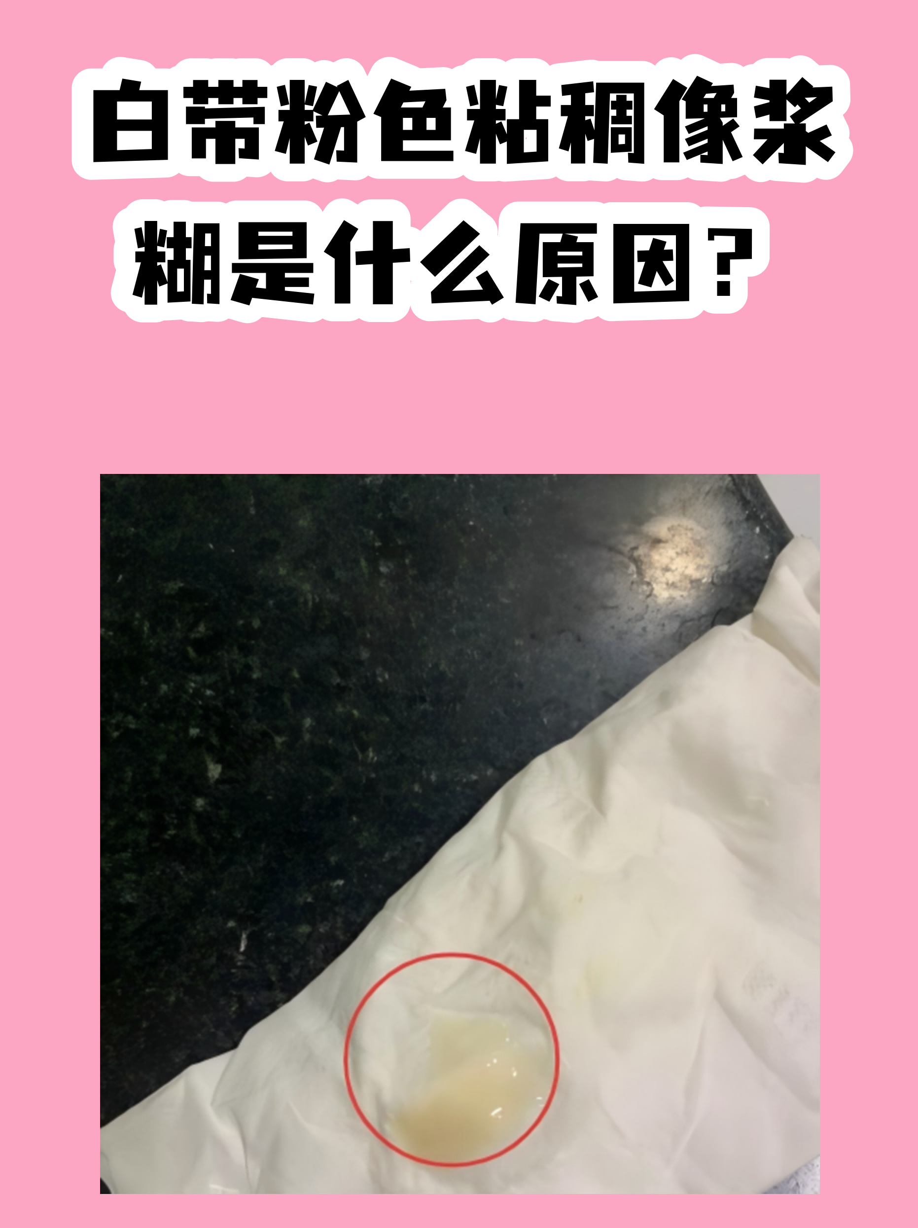白带粉色粘稠像浆糊是什么原因?