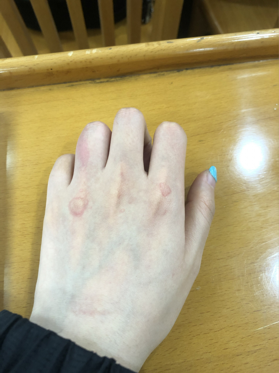 几年前夏天突然手上长了一些红斑之后每年冬天冬天都会长,百度了别人
