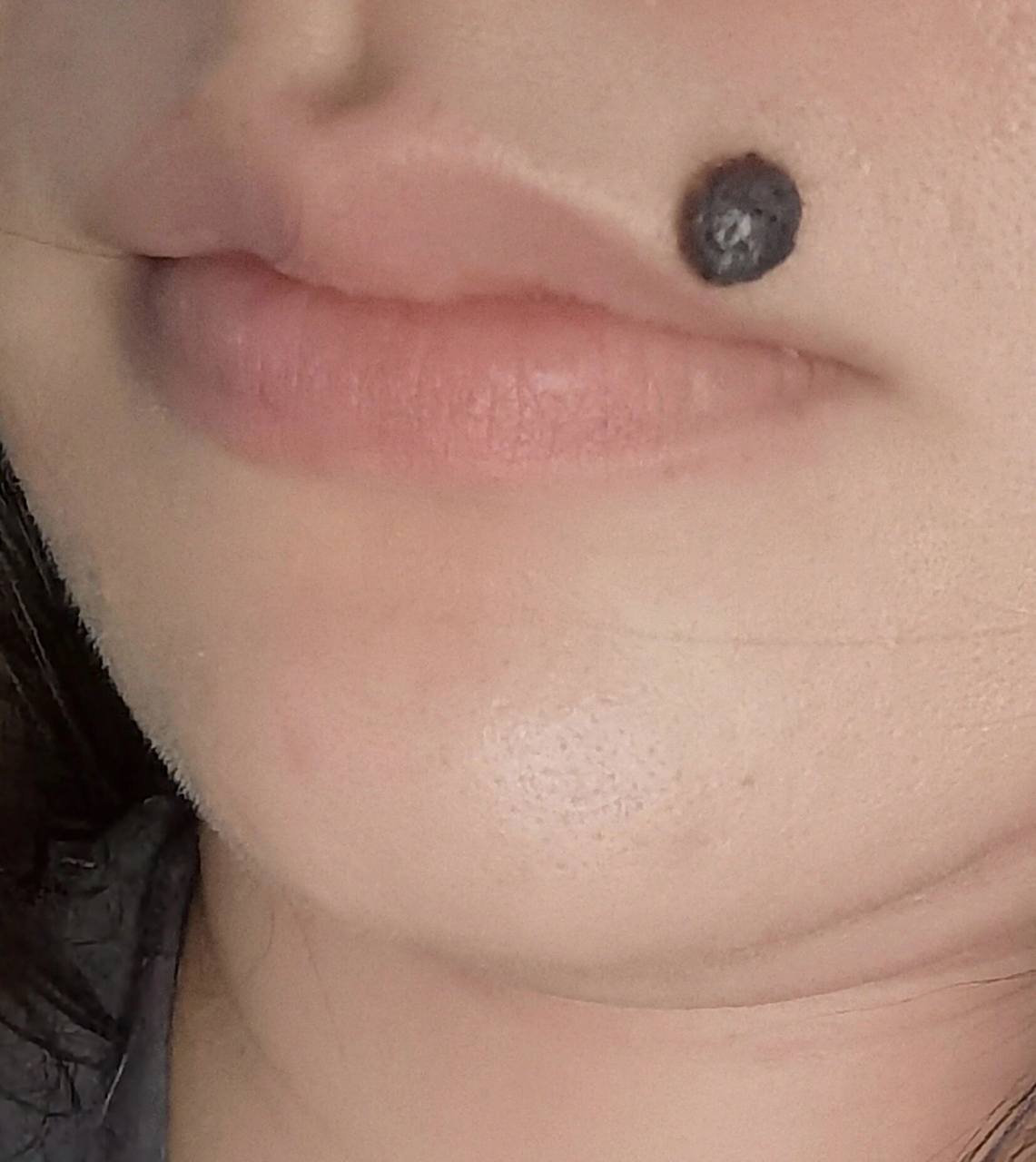 会一直大下去,也影响美观,最近有打算去做手术切掉,可是离嘴唇太近了