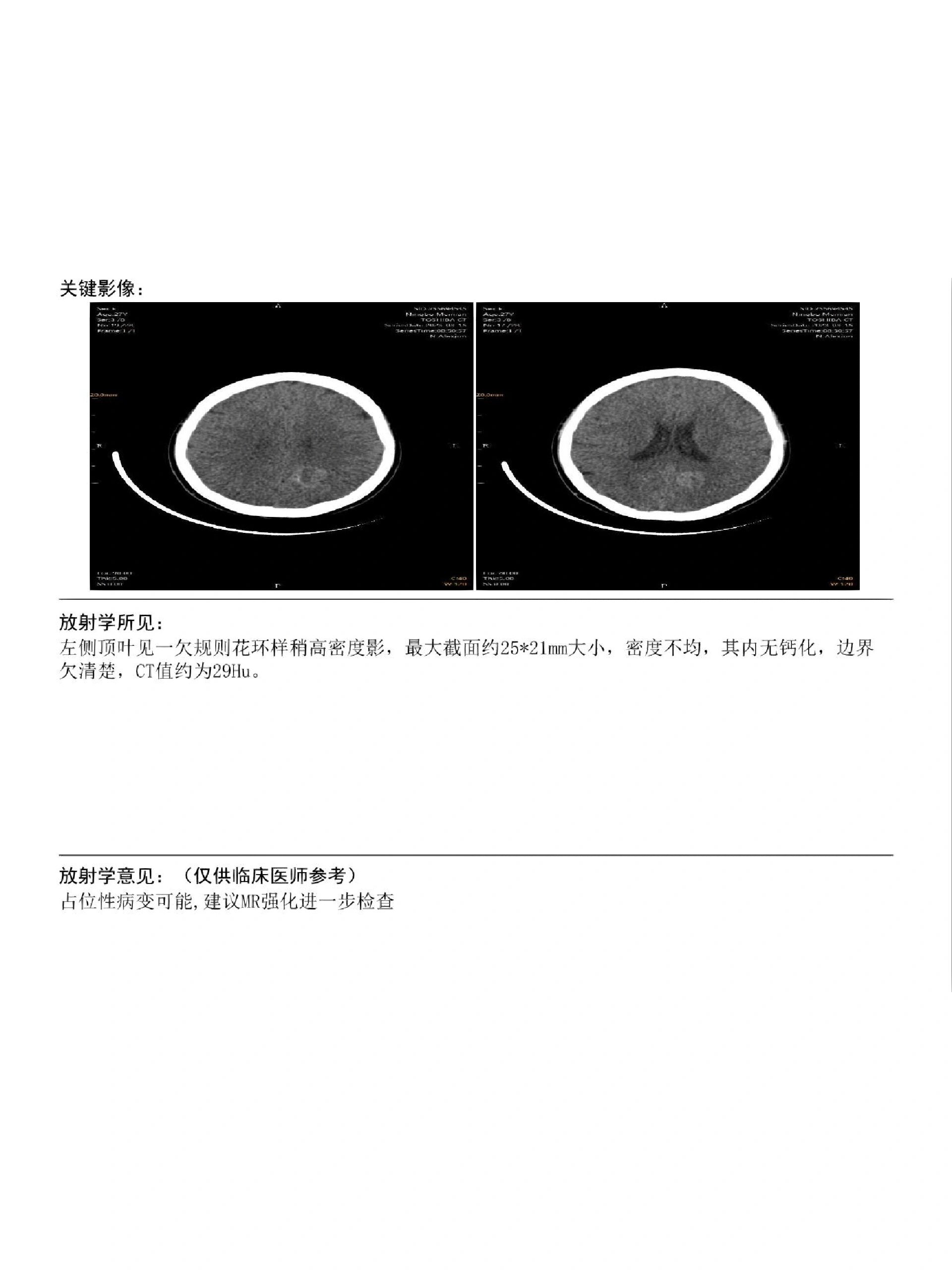 头部左侧枕叶海绵状血管瘤!
