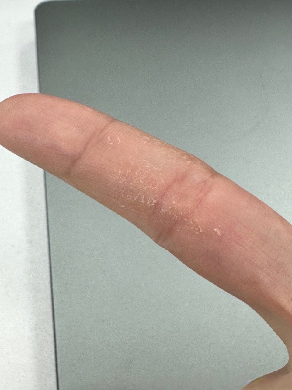 手指真菌脱皮开裂痒图图片