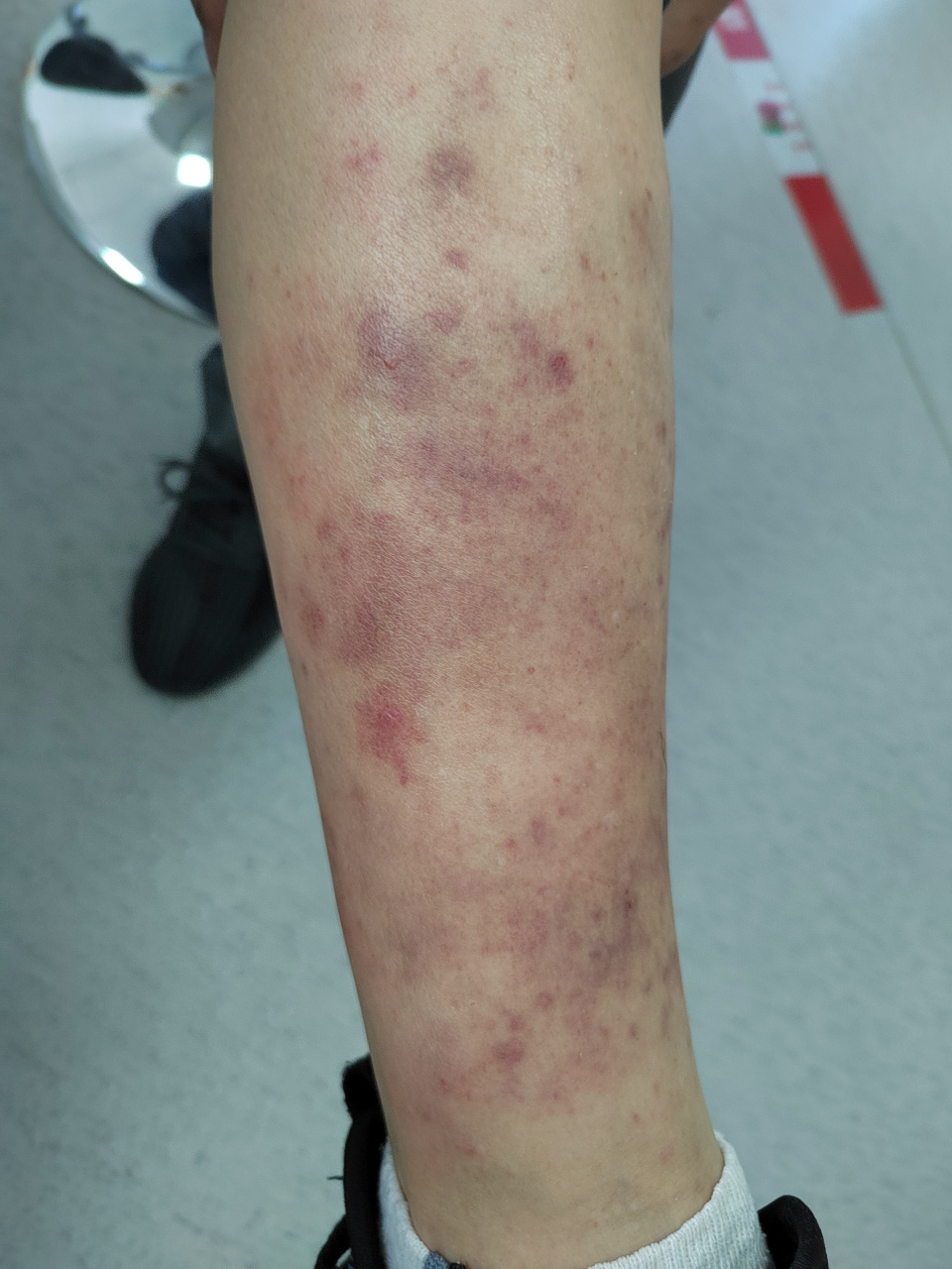 小腿部位的红斑丘疹症状.考虑夏季皮炎.