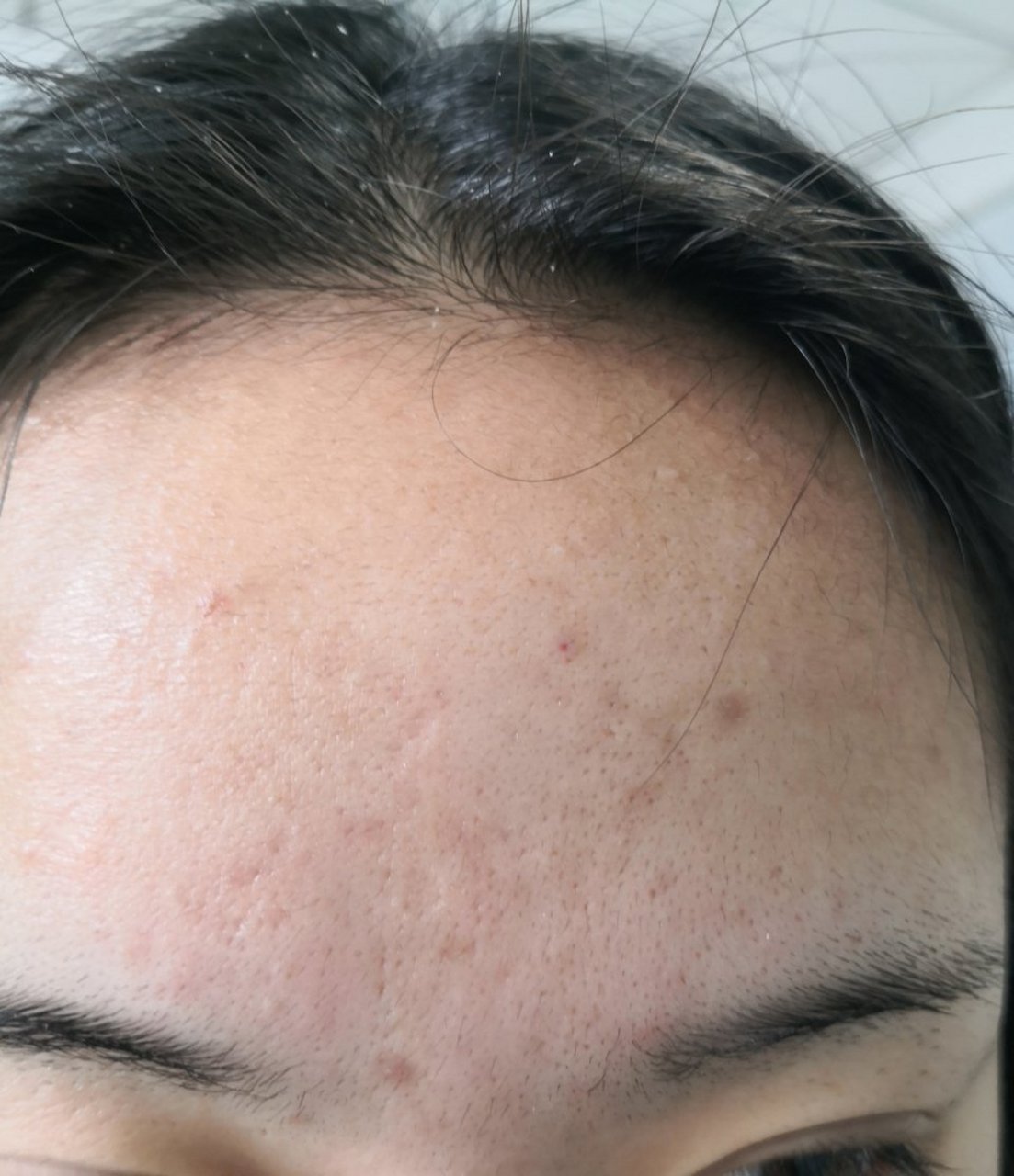 泛发性皮肤毛周角化.需要系统治疗一段时间.