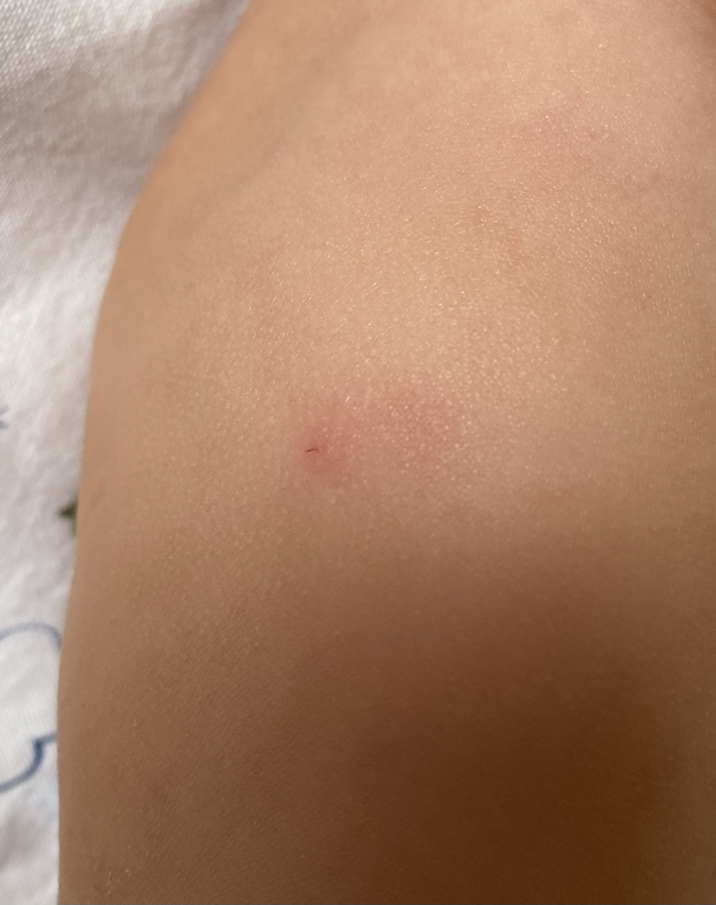 昨天带宝贝去打十三价肺炎疫苗的第一针,今天发现打针的地方又红又肿