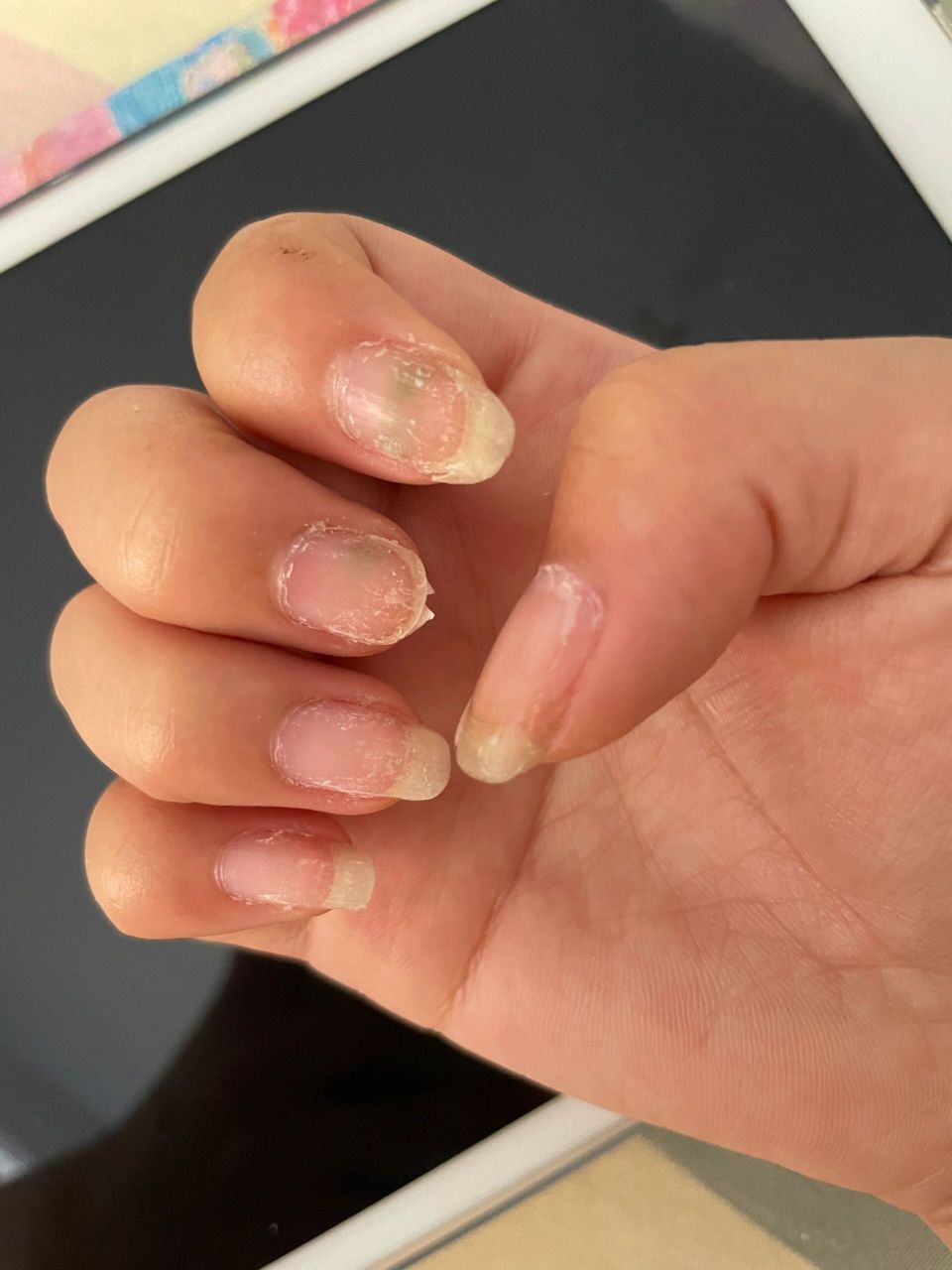 带穿戴甲今天发现指甲变绿怎么办急 急急急,指甲变绿需要去医院吗