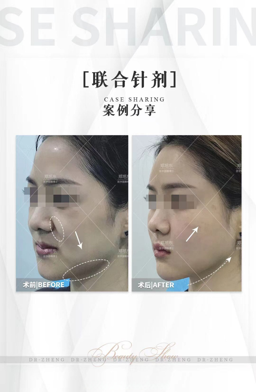 十二美相 —— 联合针剂   这位20多岁的求美者底子很不错,五官也很