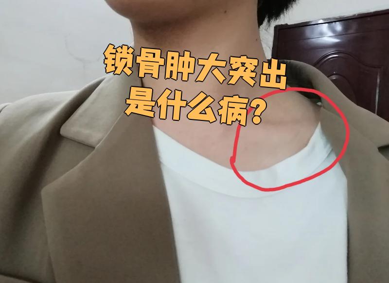这个关节位于前胸和颈下,由锁骨近端和胸骨柄连接而成,周围韧带和