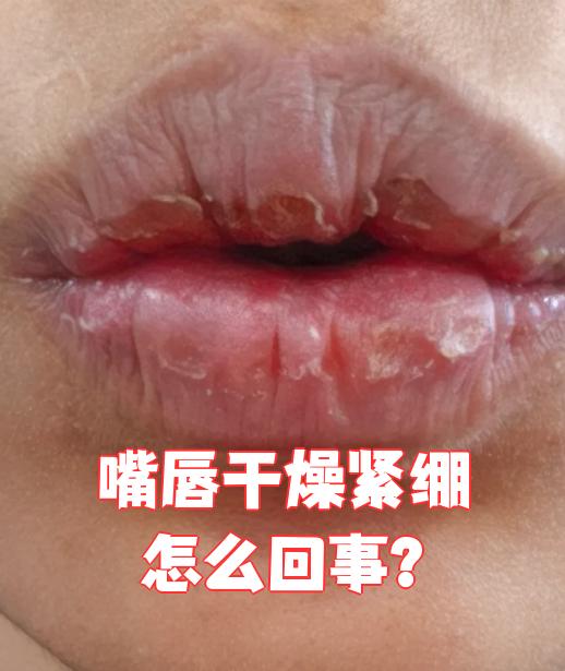 为什么嘴唇干裂一直不好百科在线