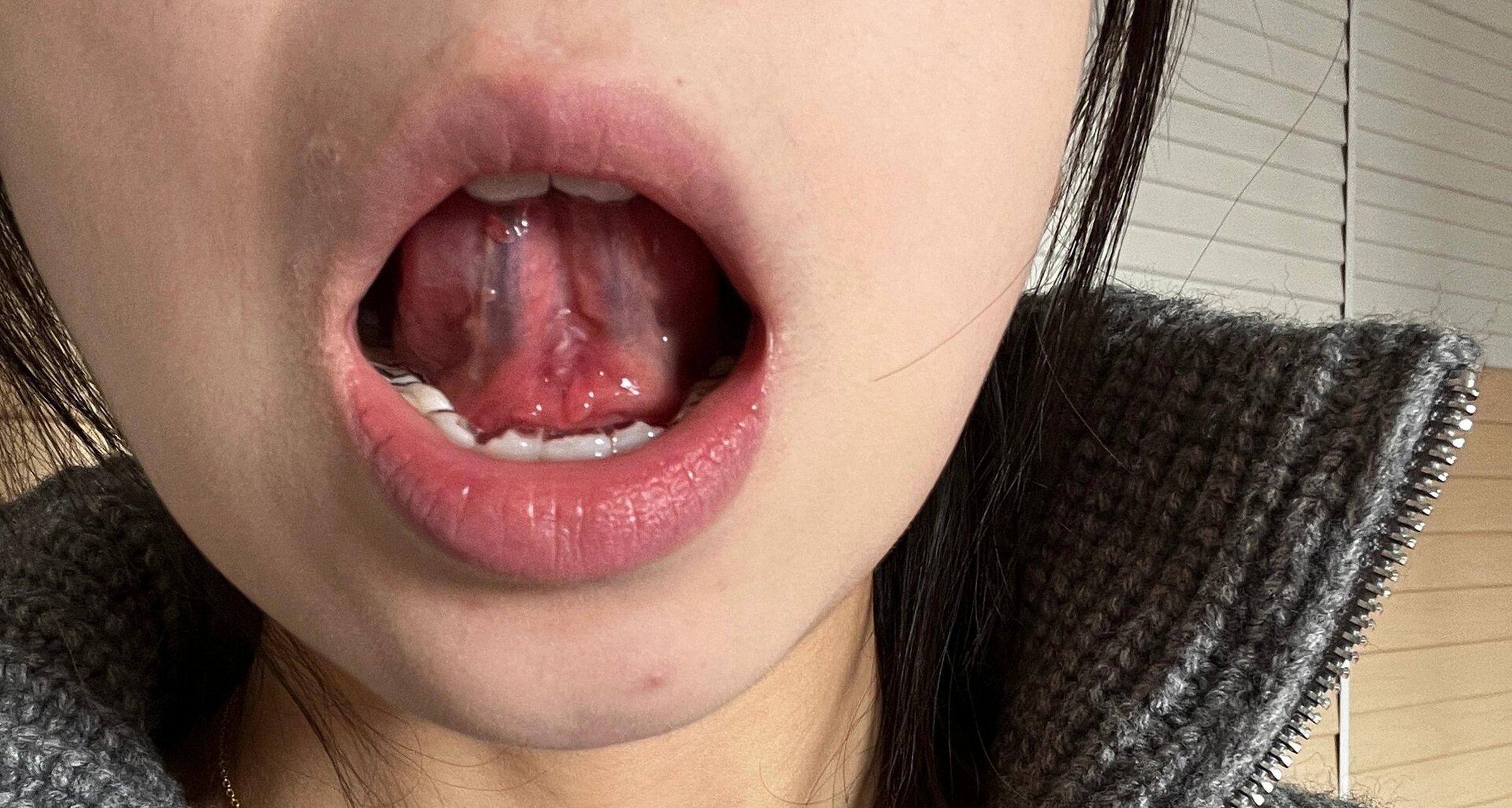 舌头根部下面疼咋回事儿 感觉睡了一觉后更疼了 下面出现了白点 不