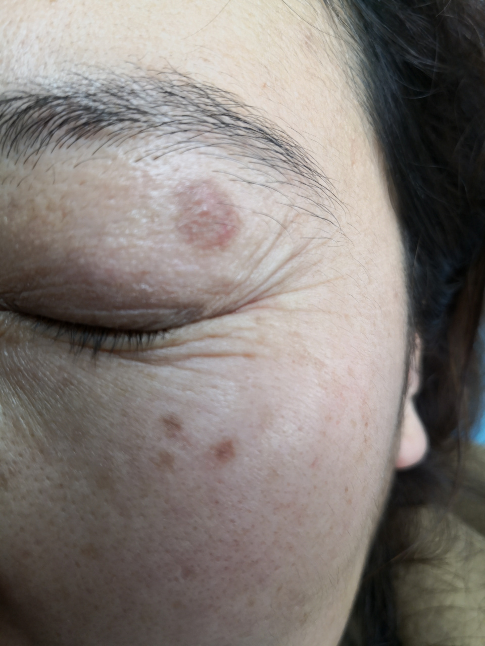 美容##激光美容##色素沉着