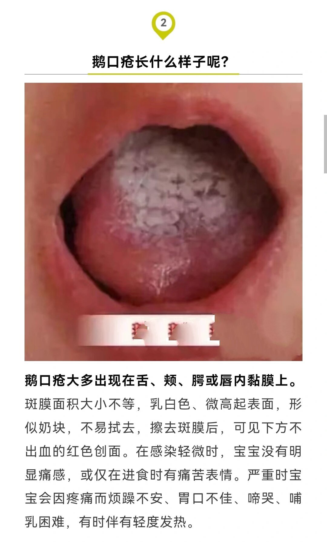 宝爸宝妈不用慌,教你正处理鹅口疮