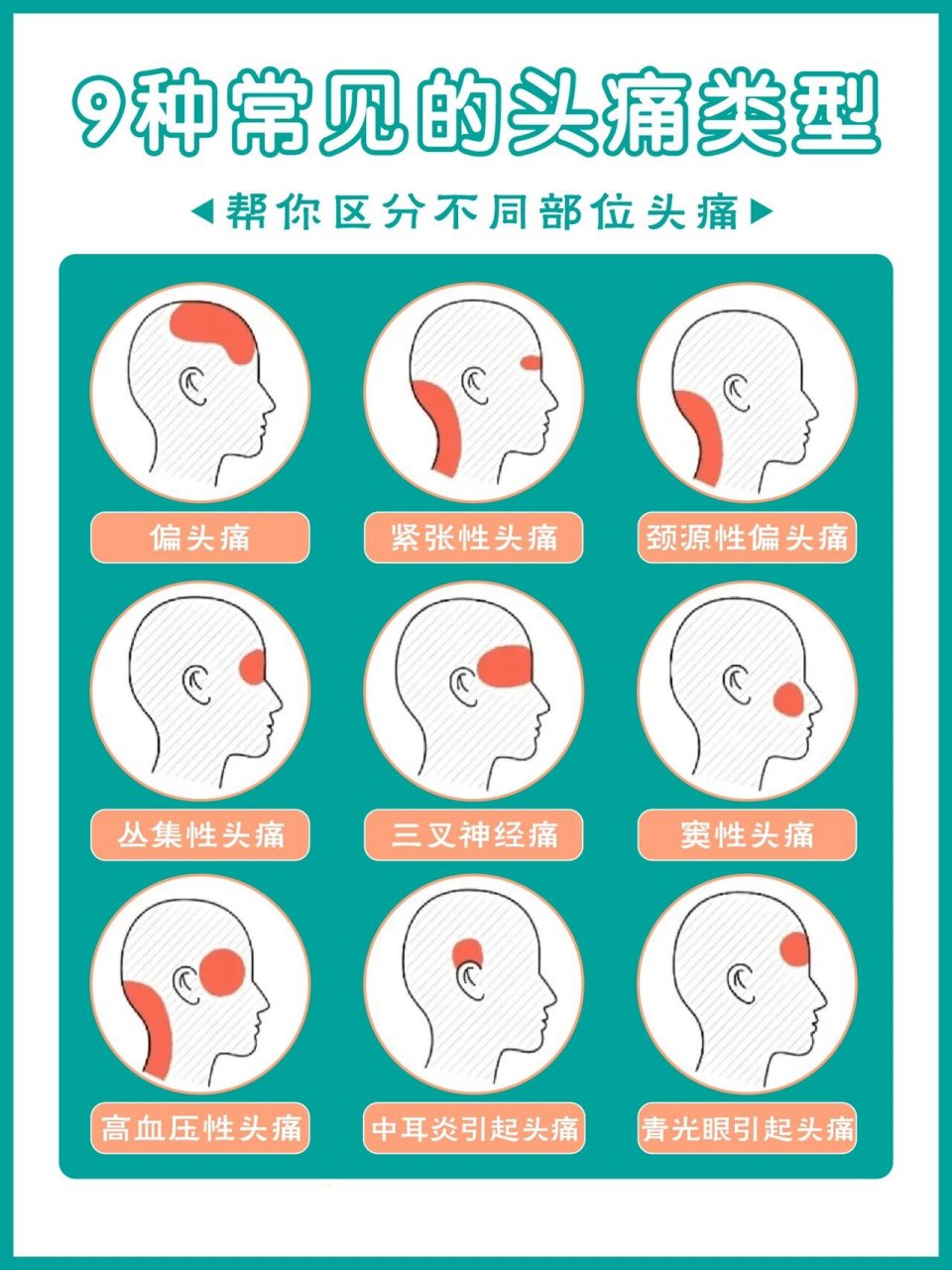 好发部位为头部一侧,大多数以头额部,颞部,两边太阳穴为主.
