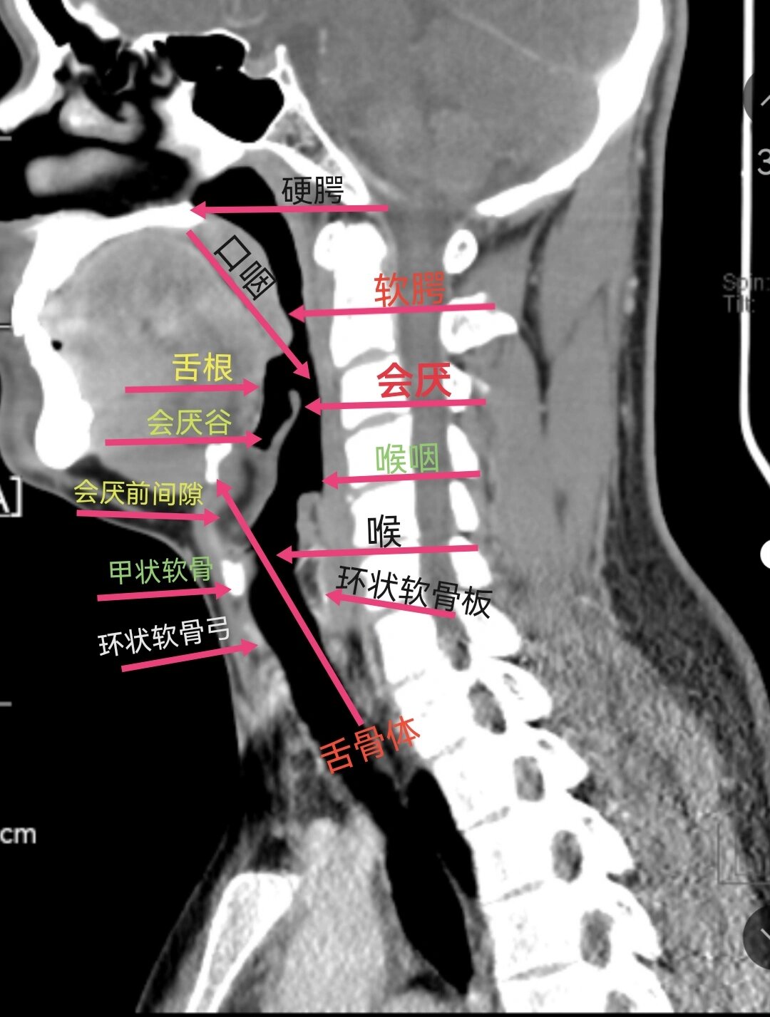 硬腭CT断层图像图片