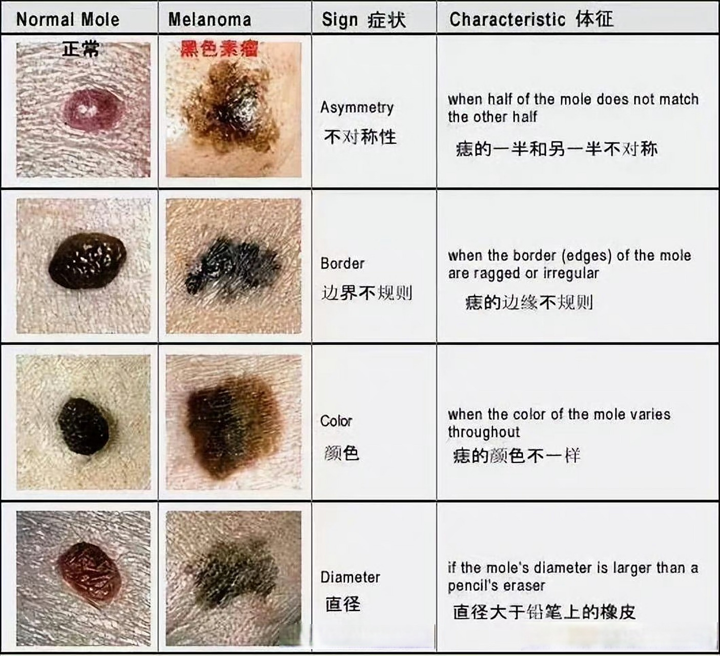 好声音学员张恒远因黑色素瘤去世,一张图教你黑色素瘤和痣怎么区分!