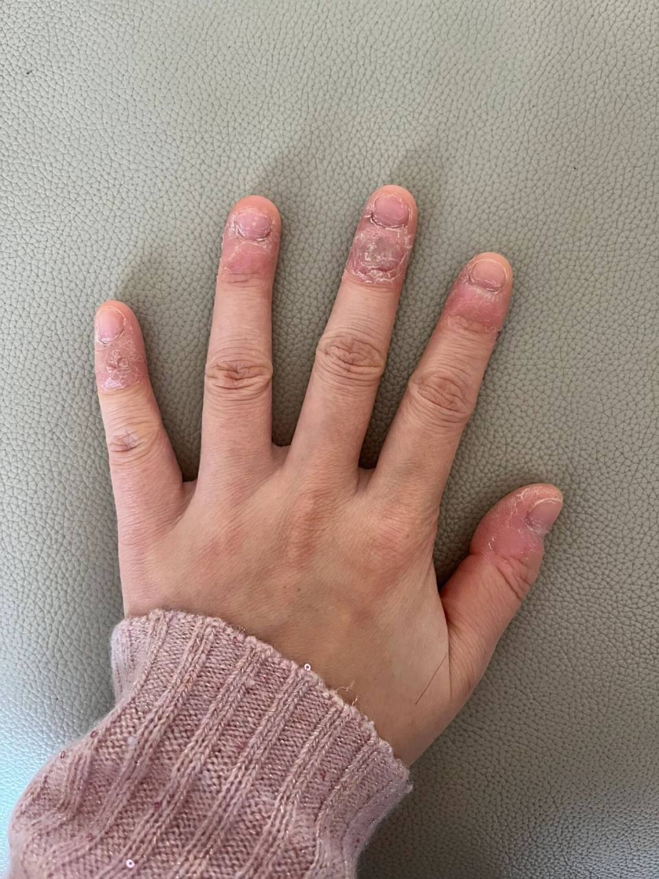 挑战全网最丑手… 从小就有抠手的习惯,一直到现在,还是很难戒掉.