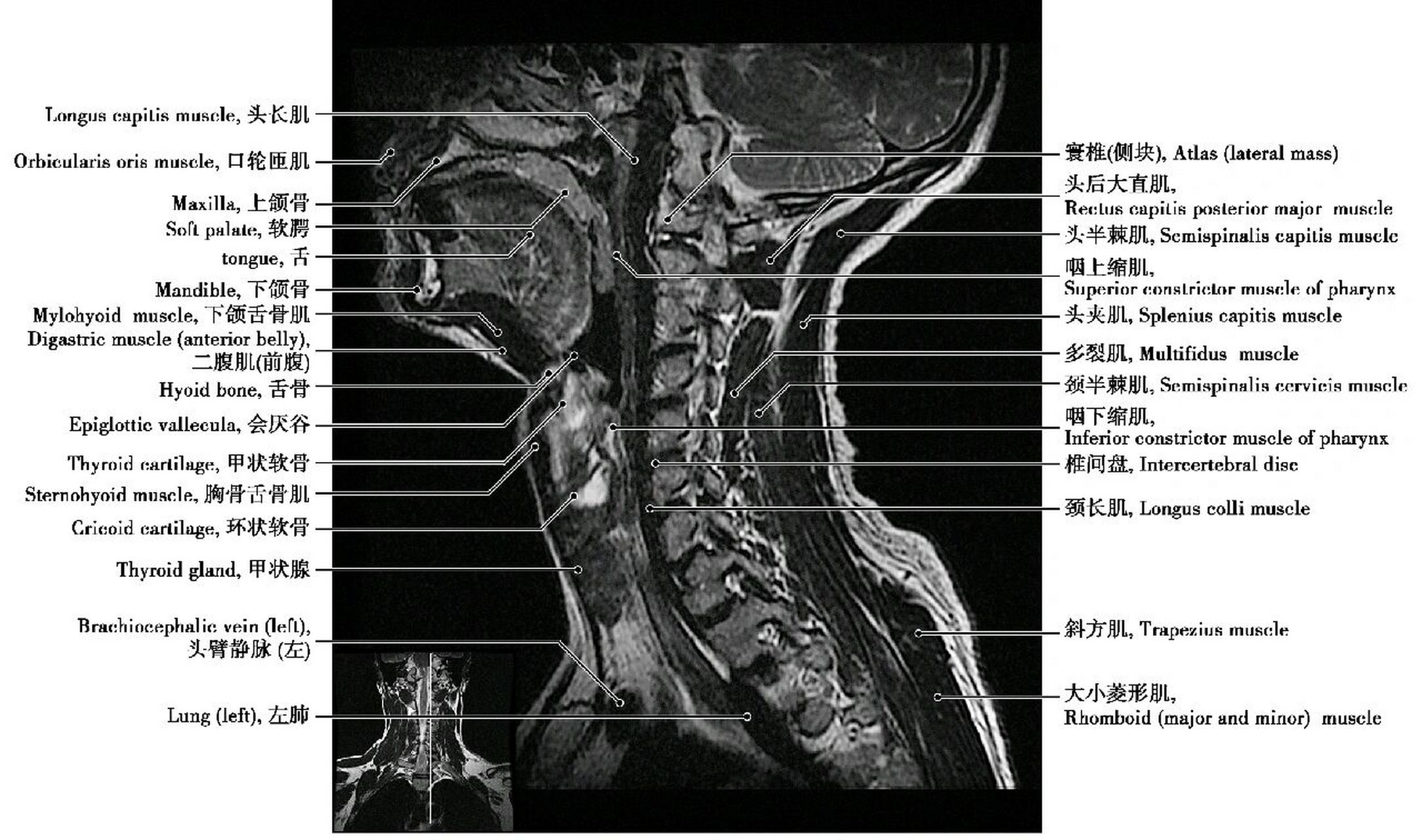 颈椎磁共振解剖图片