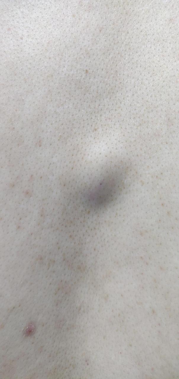 体表的包块和肿物,有时候不需要做b超,临床大夫凭经验就可以判定做出