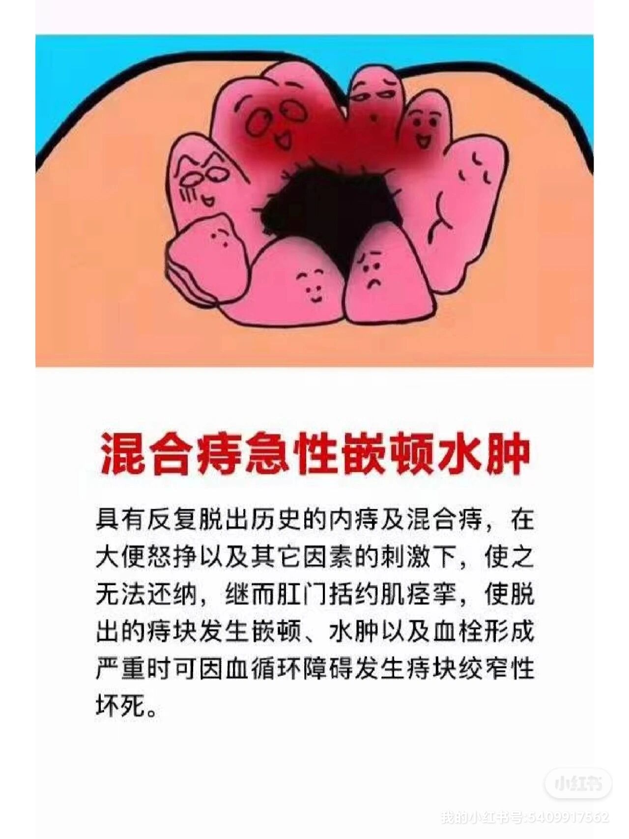 痔疮嵌顿是什么意思图片