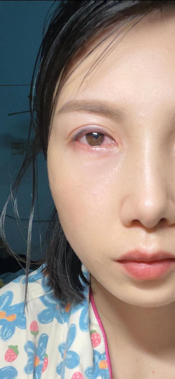 闺女的小手指,把我的眼角膜戳掉了一块🥵