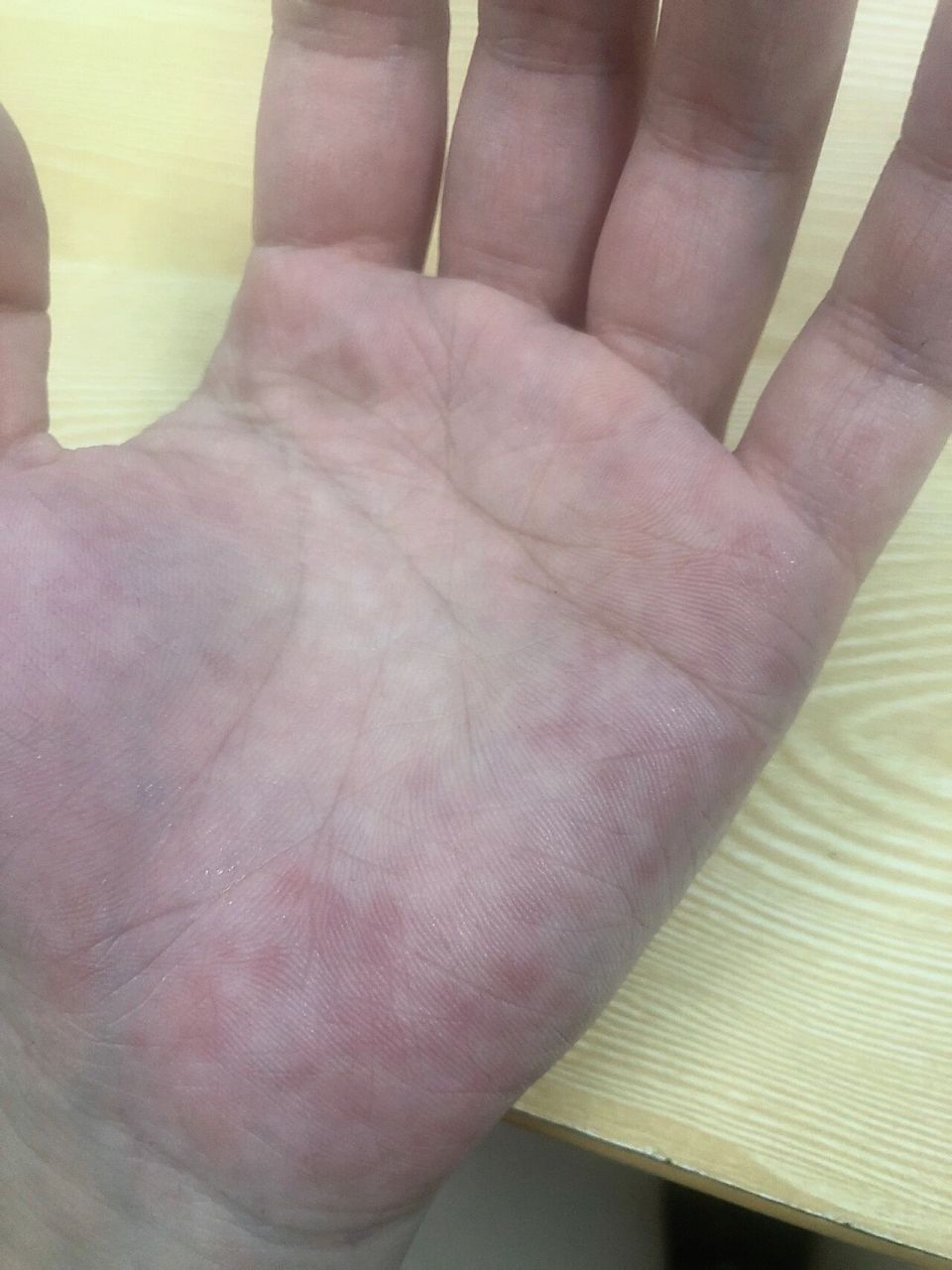 有没有同款手会这样子的,很痒,都不知道什么原因会这样子的