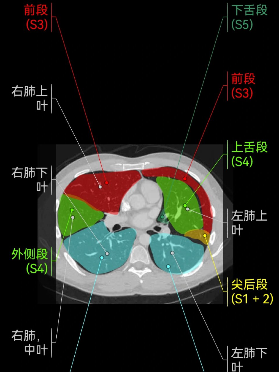 正常肺ct片图片图解图片