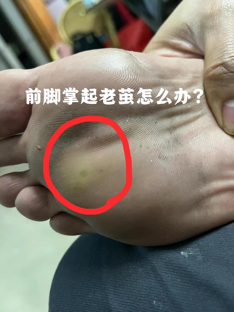 前掌反复起老茧/横弓塌陷怎么办 这个小垫子叫趾骨垫,是硅胶材质的